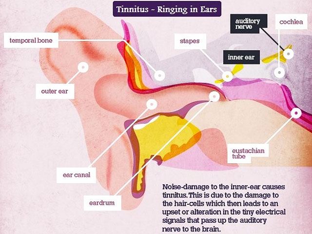 Migraine with Ringing in Ears: Causes, Treatment, and More