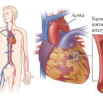 Blocked Coronary Arteries - Things You Should Know But Didn't !