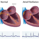 A Guide to Atrial Fibrillation