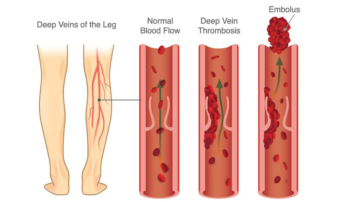 An Overview on Deep Vein Thrombosis (DVT) - Medical Tourism in India ...