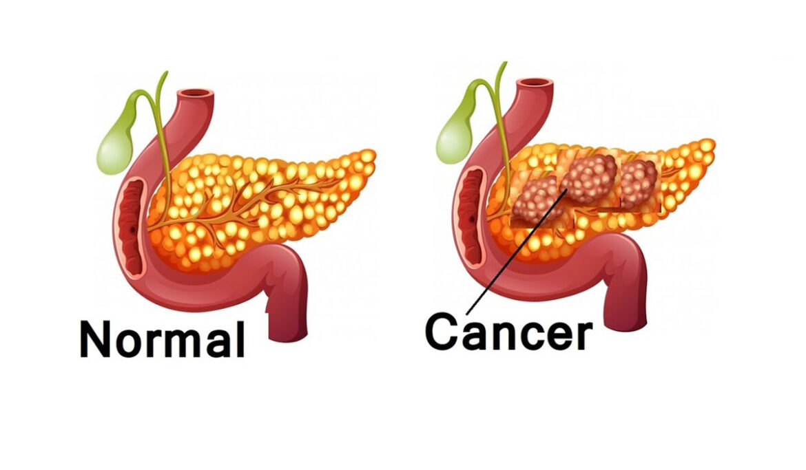 Pancreatic Cancer Treatment In India Best Doctors For Surgery Cost