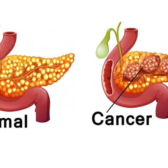 Cancer Treatment in India | Cancer Hospitals | Cost | Surgeons