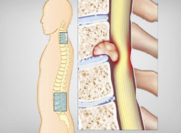 Spinal Tumor Surgery Cost in India | Hospitals | Spine Surgeons