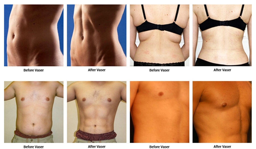 Vaser Liposuction Cost in India, Hospitals