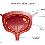 Bladder Cancer in Men: Everything You Need to Know About